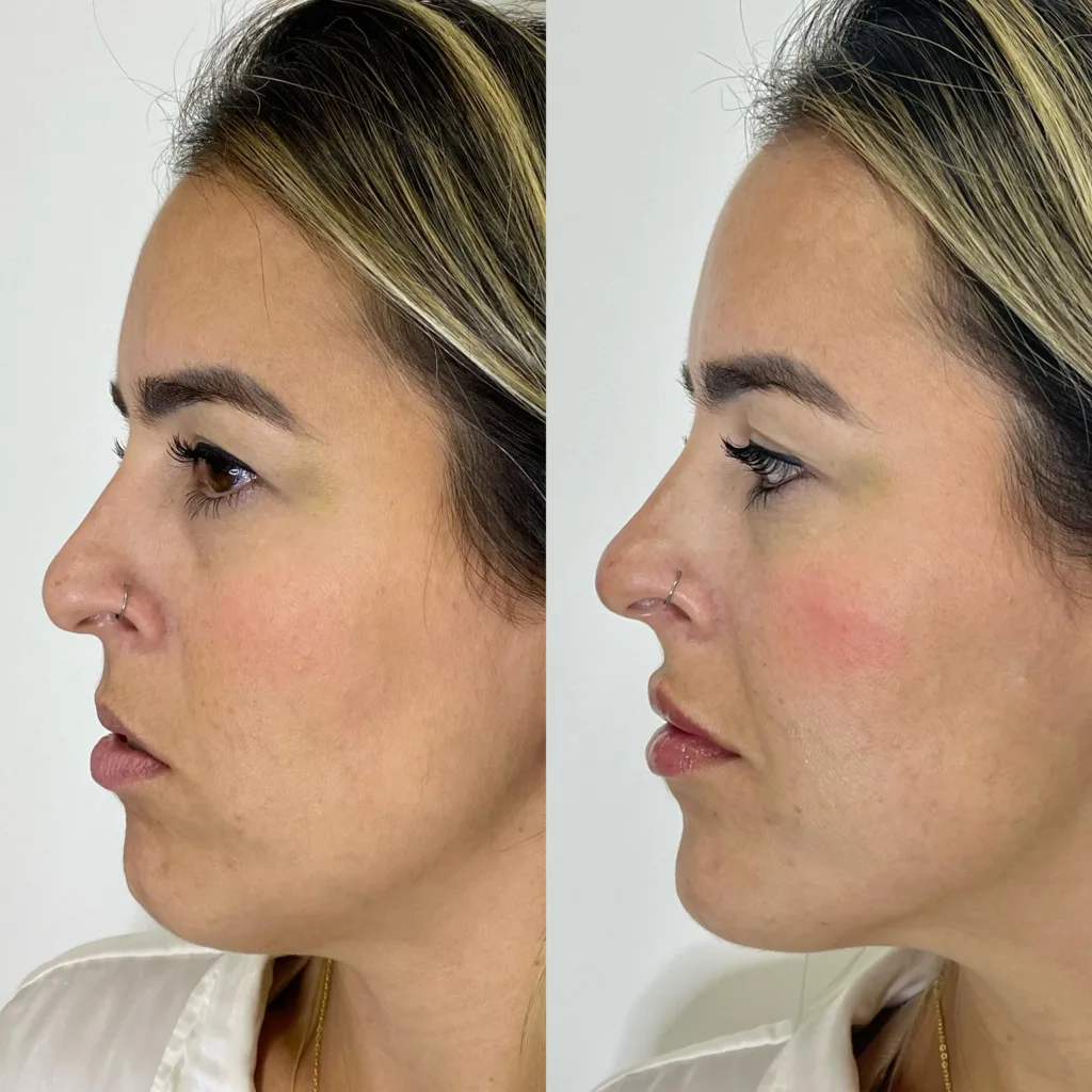 paciente do living em antes e depois da harmonização facial.