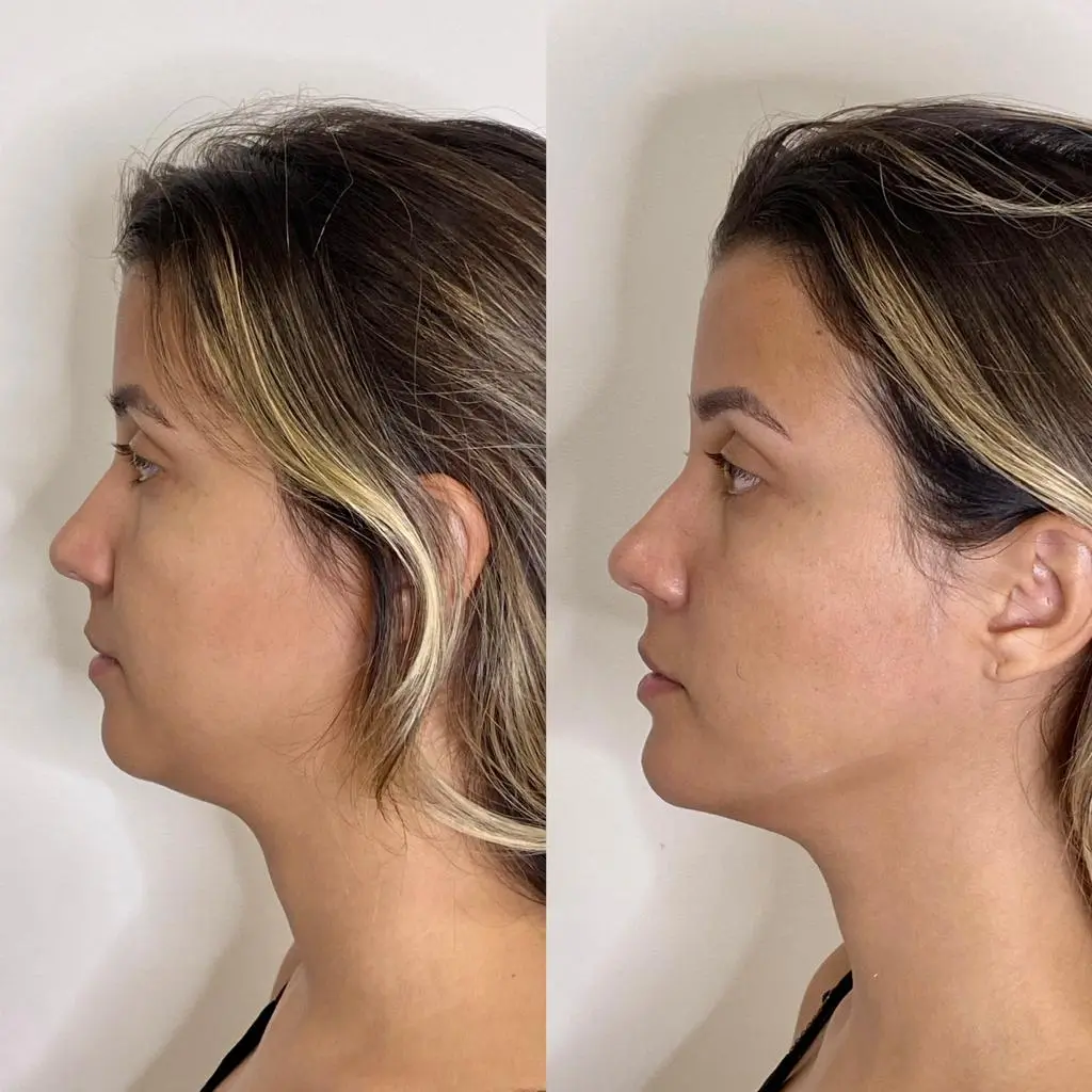 paciente do living após harmonização facial.