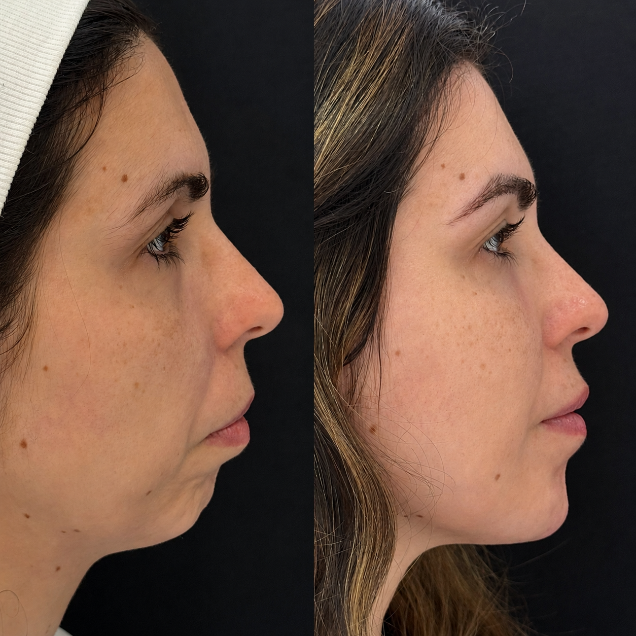 Harmonização facial - resultado 1