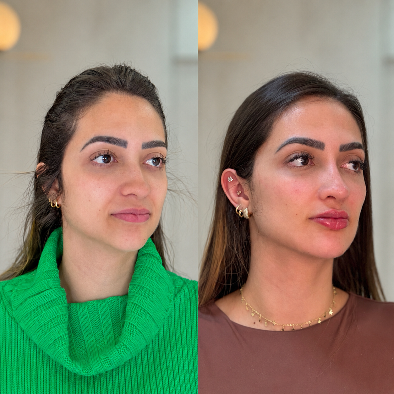 Harmonização facial - resultado 2