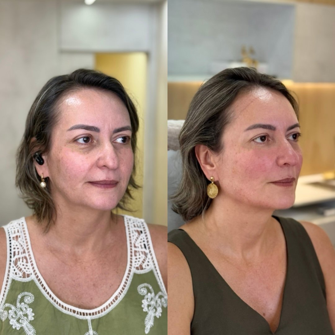 Harmonização facial - resultado 3